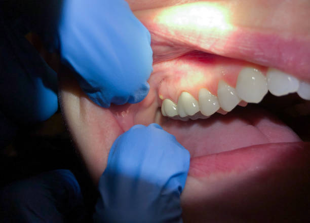 Urgent Tooth Repair in MT